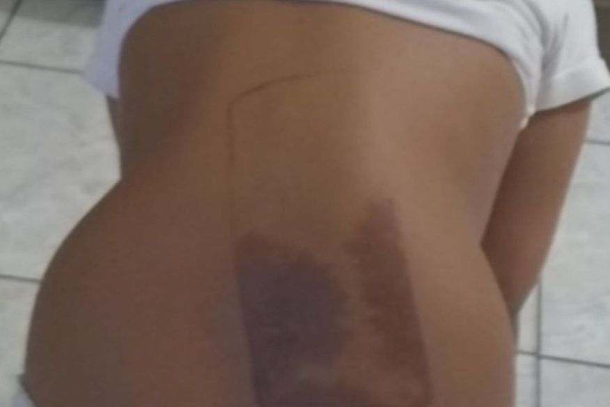 Criança de 7 anos sofre queimaduras nas costas após dormir em cima do celular