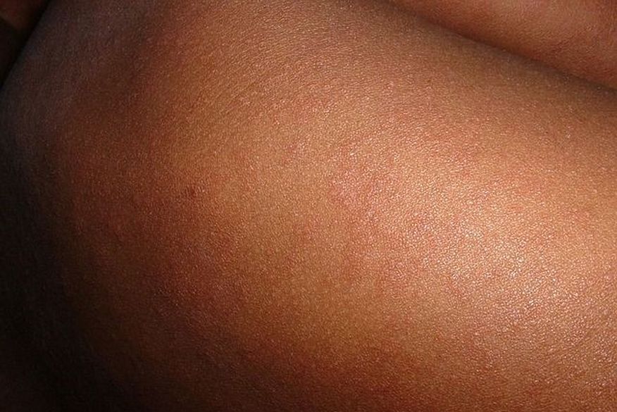 Paraíba investiga primeiro caso suspeito de sarampo, em dois anos, em bebê de cinco meses de vida