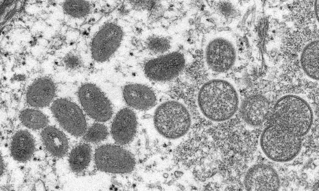 Anvisa orienta hospitais sobre casos de varíola dos macacos
