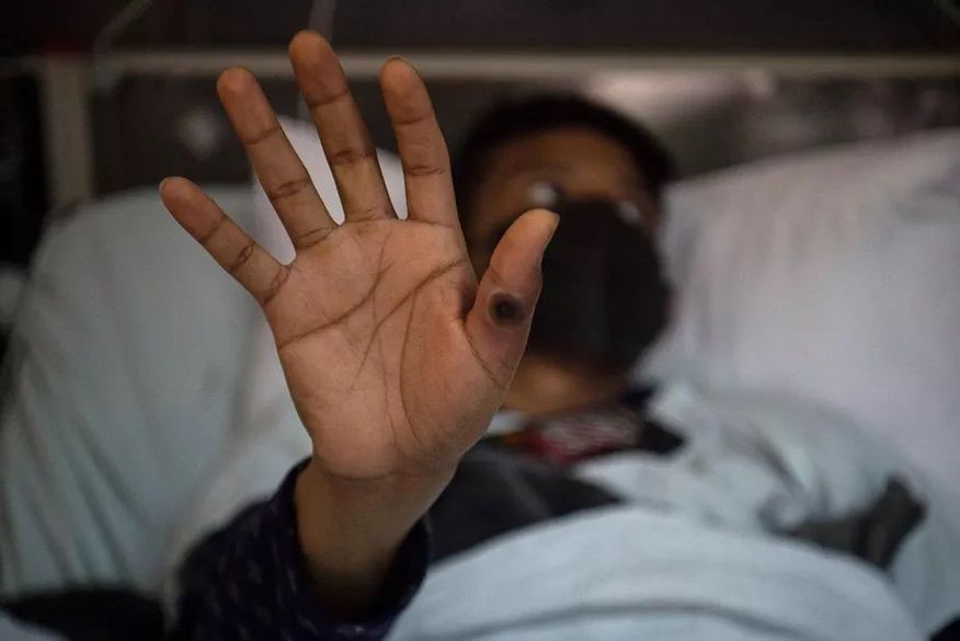 Homem testa positivo para varíola dos macacos, Covid-19 e HIV, em caso inédito