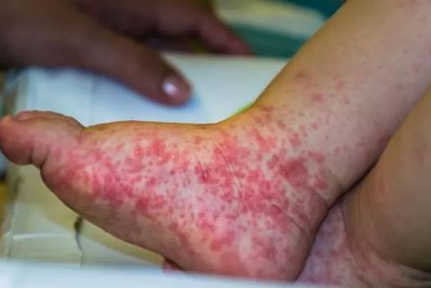 ‘Gripe do tomate’: o que é o novo vírus identificado na Índia